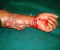 3rd case Post operation