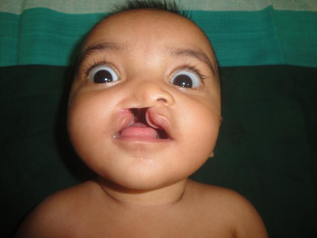 CLEFT