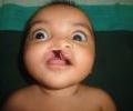 CLEFT
